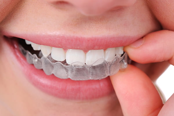 التقويم الشفاف للأسنان: تحول فريد نحو الابتسامة المثالية 8 1592529447 688 155272 Tijan Dental Center