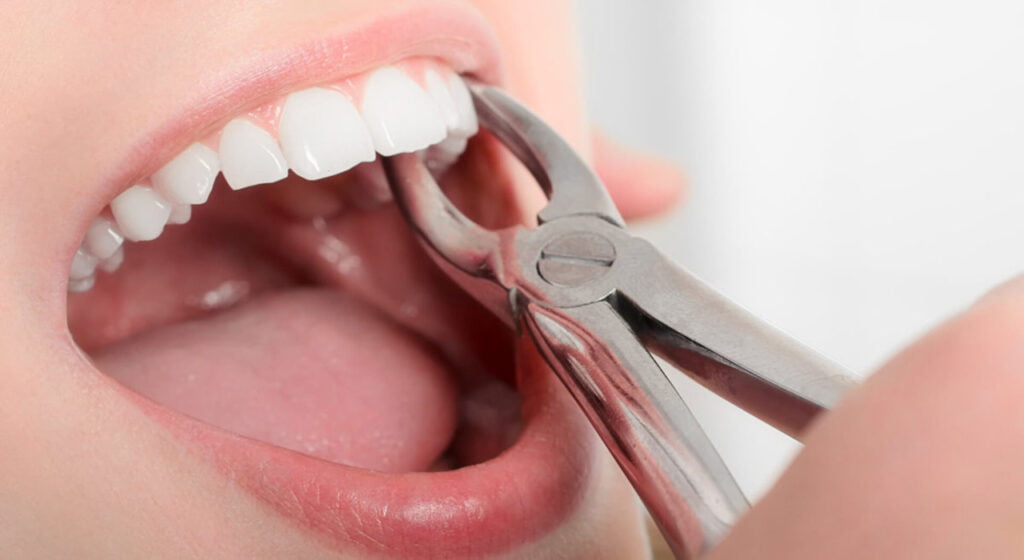 كل ما تحتاج لمعرفته عن خلع الأسنان للكبار والأطفال 6 خلع الاسنان اسبابه