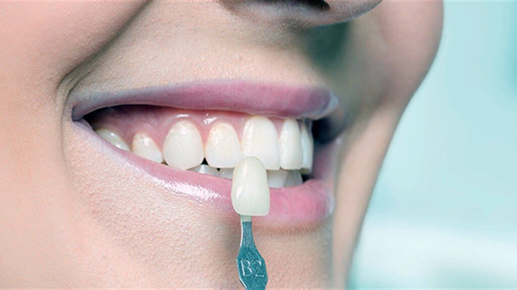 عدسات الأسنان لابتسامة مثالية: استكشف الفوائد والبدائل 1 عدسات الأسنان لابتسامة مثالية: استكشف الفوائد والبدائل