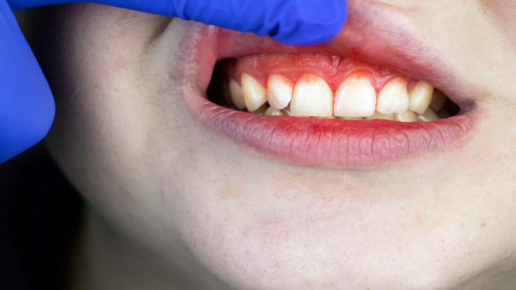 كيفية التعامل مع التهاب اللثة أثناء الحمل - Tijan Dental Center