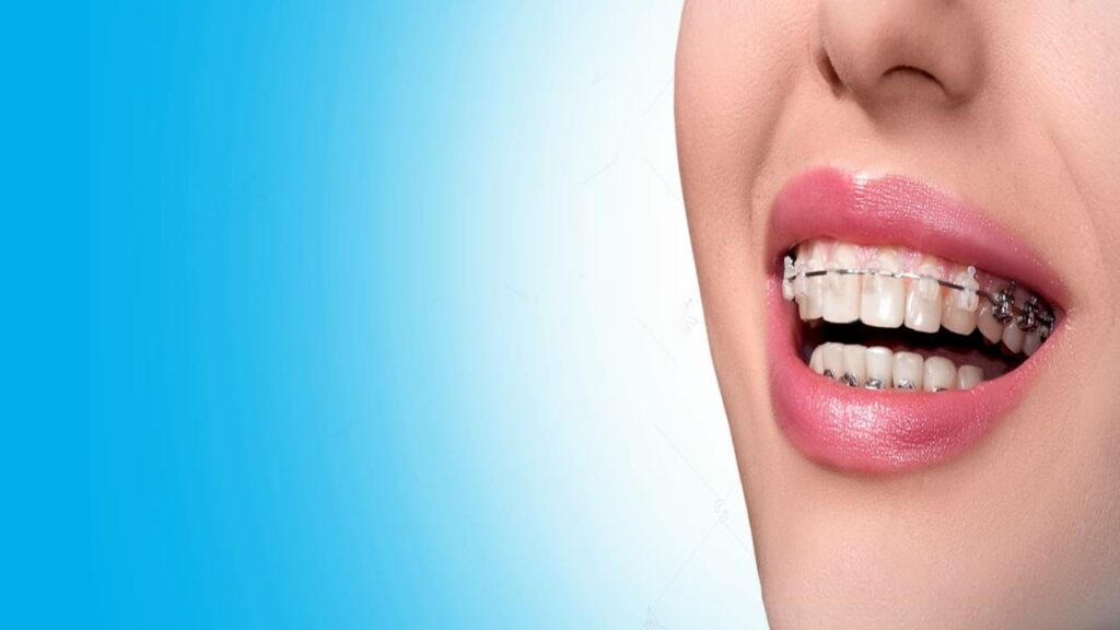 تقويم الأسنان: الفوائد، العيوب، وكيفية الحفاظ على النتائج 8 تقويم الأسنان