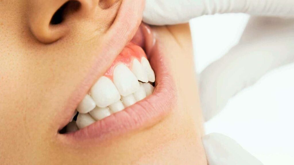 علاج خراج الأسنان وأعراضه: دليل شامل للتعامل مع الالتهاب 4 خراج الأسنان