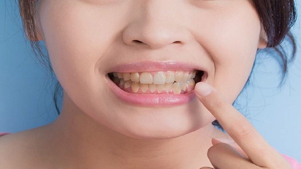أسباب وعلاج اصفرار الأسنان: دليل شامل لتبييض الأسنان 7 اصفرار الأسنان