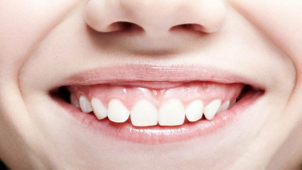 الابتسامة اللثوية وعلاجها بالتقويم والفيلر: كل ما تحتاج معرفته 10 الابتسامة اللثوية