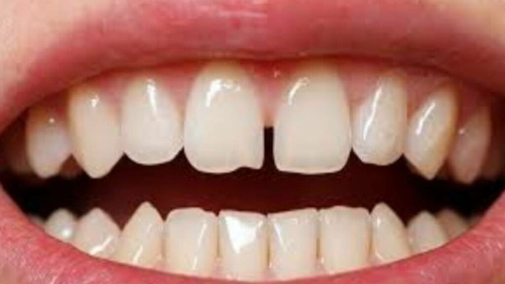 أسباب الفجوات بين الأسنان وعلاجها: دليل شامل 5 الفجوات بين الأسنان
