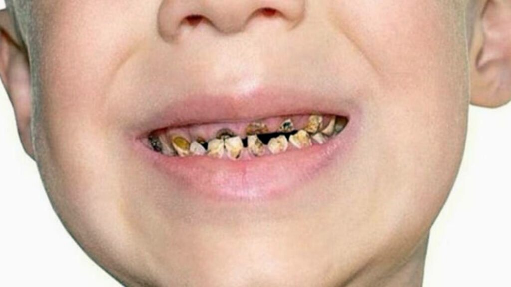 تآكل الأسنان: هل يمكن علاجه؟ تعرف على الأعراض والأسباب 9 تآكل الأسنان