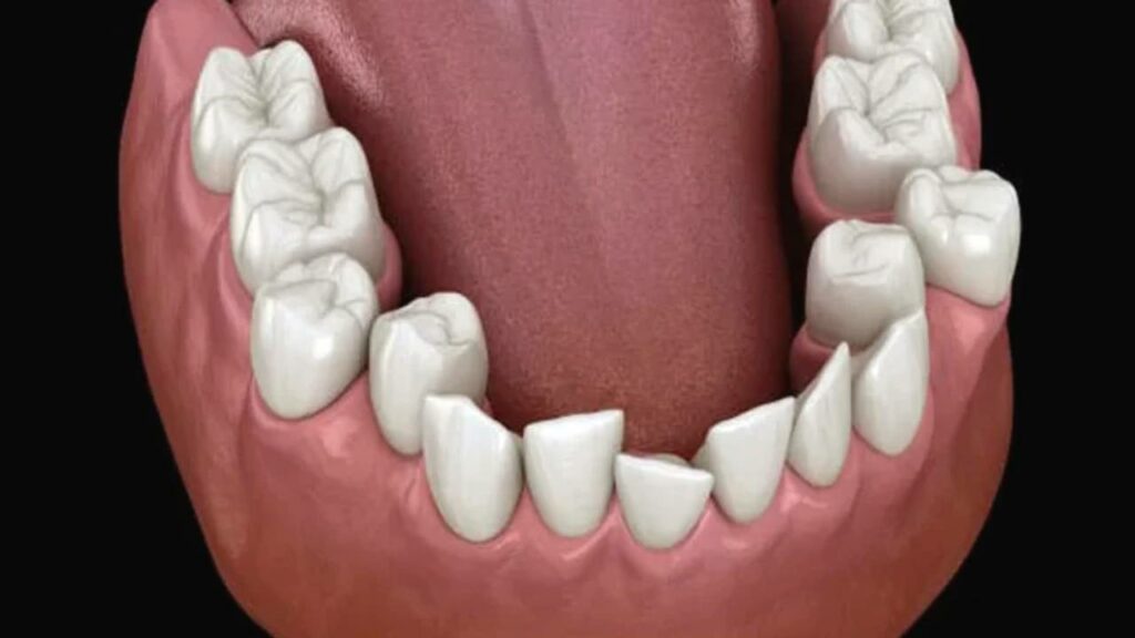 مشاكل تزاحم الأسنان وكيفية علاجها 4 تزاحم الأسنان