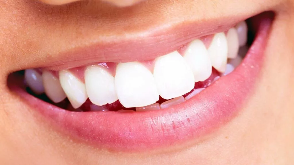 جسر الأسنان