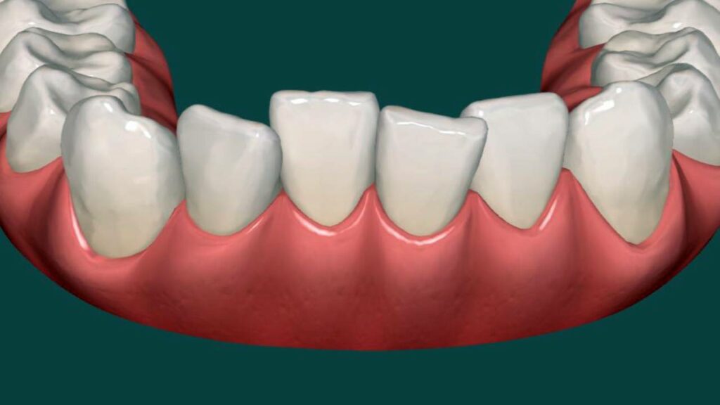 مشاكل تزاحم الأسنان وكيفية علاجها 1 مشاكل تزاحم الأسنان وكيفية علاجها 1 Tijan Dental Center