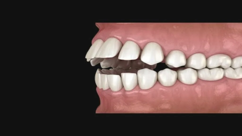 العضة المفتوحة