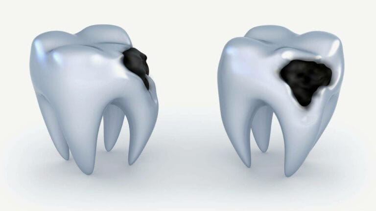 مراحل تسوس الأسنان: الأسباب، الأعراض، والعلاج الفعّال - Tijan Dental Center